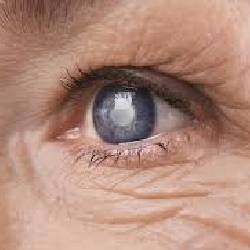 Cataract Surgery