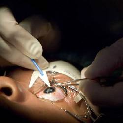 Lasik Surgery